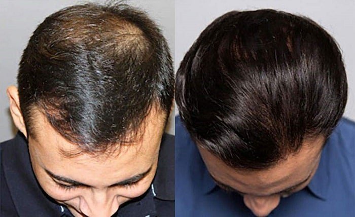 Hair Loss Stages