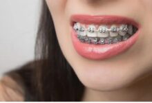 Orthodontic Journey