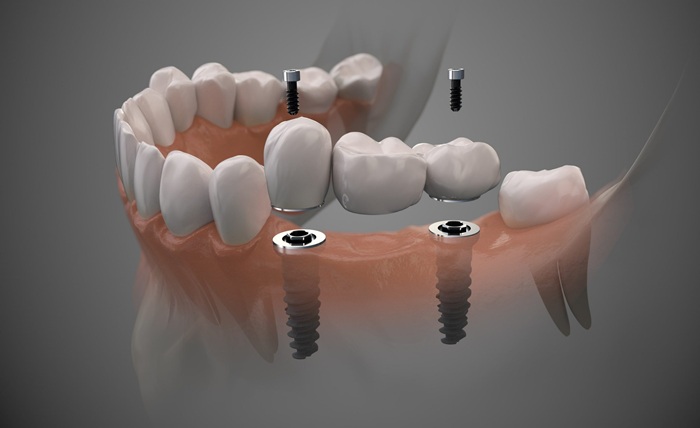 Dental Restorations