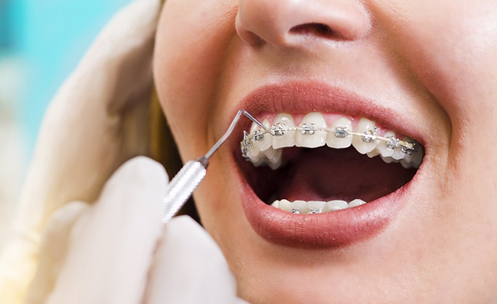 Orthodontic Treatment