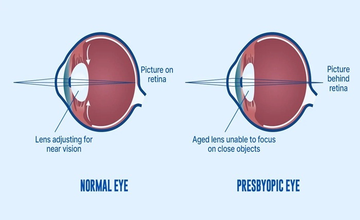 Presbyopic