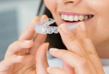 Clear Aligners