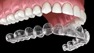Tidal Aligners