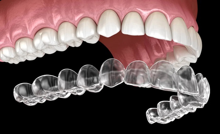 Tidal Aligners